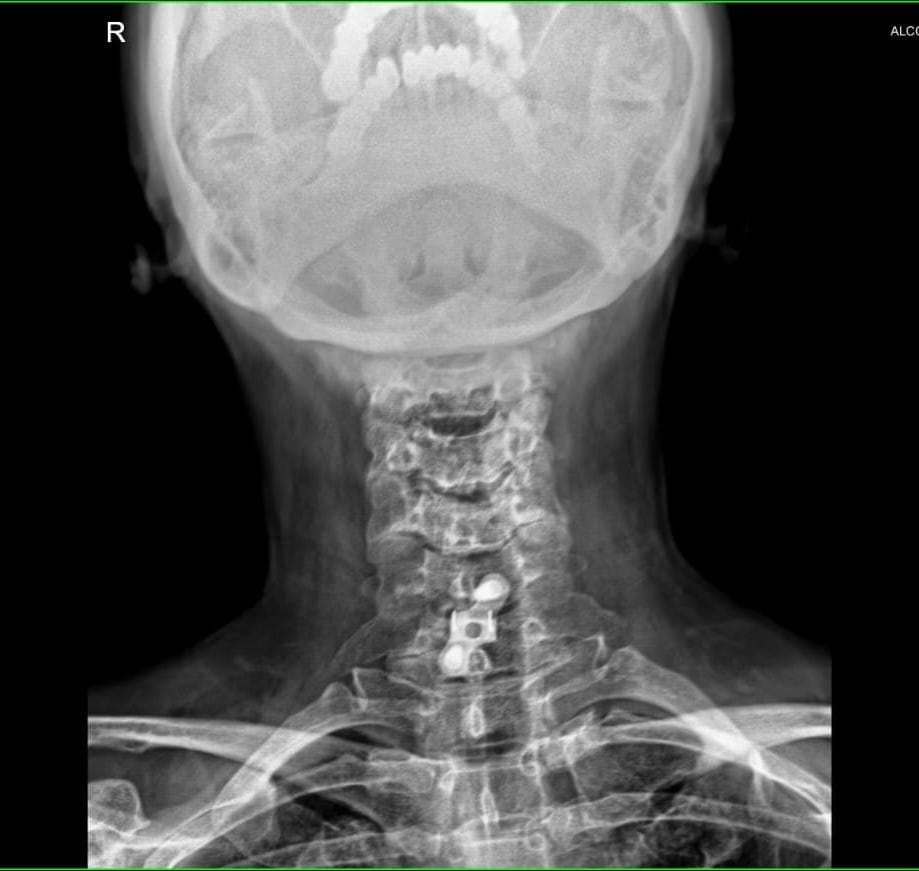 Radiografía digital de columna cervical en proyección AP
