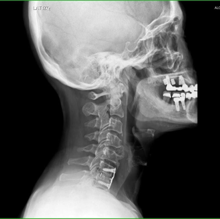 Radiografía lateral de columna cervical con material de osteosíntesis